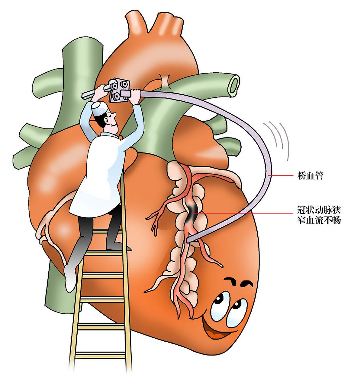 心脏介入手术漫画图片