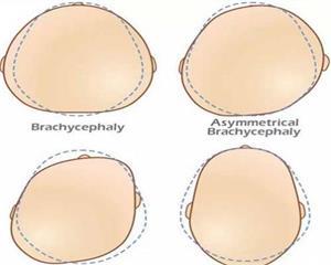 顺产宝宝头挤变形图片