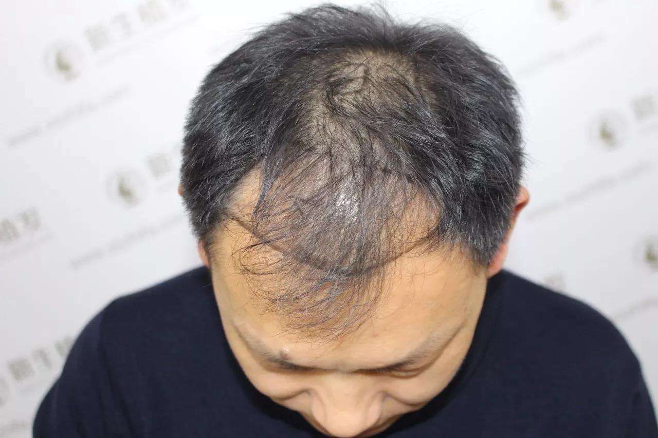 男性脱发的6大原因,男性脱发如何防治?教你4个防脱小妙招