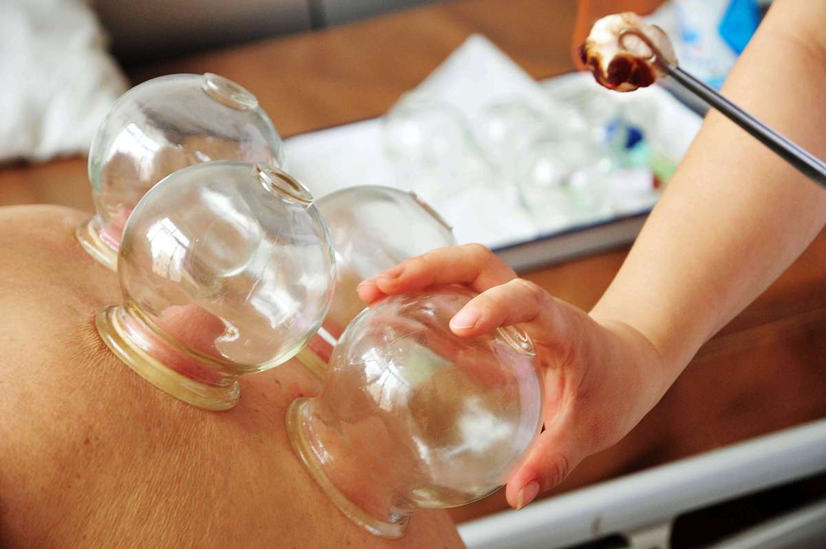 拔罐图片高清图片拔罐疗法拔罐治疗拔罐图片高清图拔罐手法图片大全