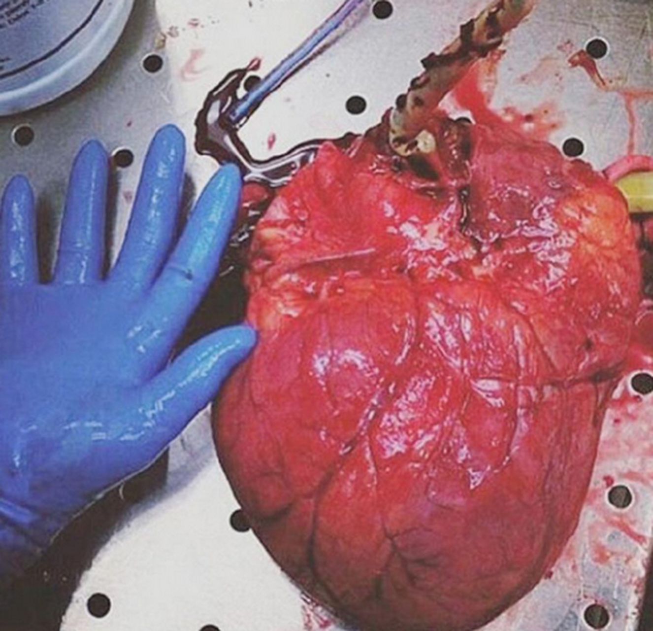 心脏扩大(cardiac dilatation),指心脏各房室增大,心脏形状发生改变.