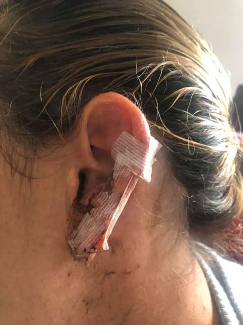 外国一酒吧工作人员被一名女子咬掉半个耳朵 受伤严重