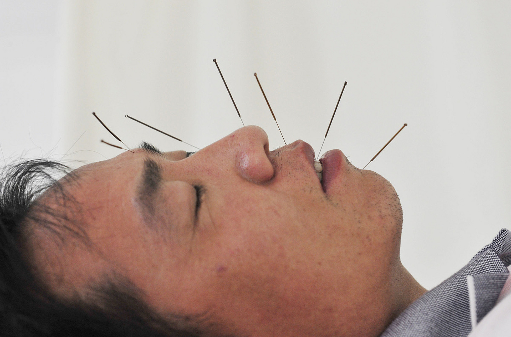 小儿面瘫怎么办? 小儿面瘫最佳治疗是以药物治疗为主.因为一般小孩对