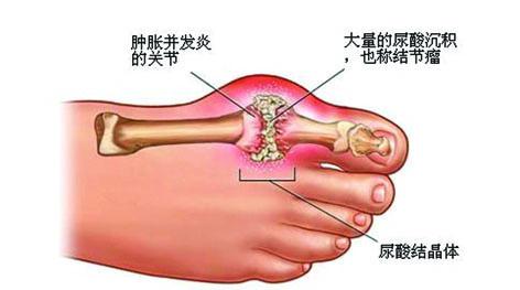 痛风急性发作图片