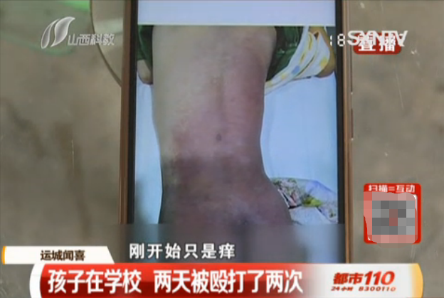 高中生遭校园霸凌,被殴打致趾骨骨折,背部到臀部整片淤紫!