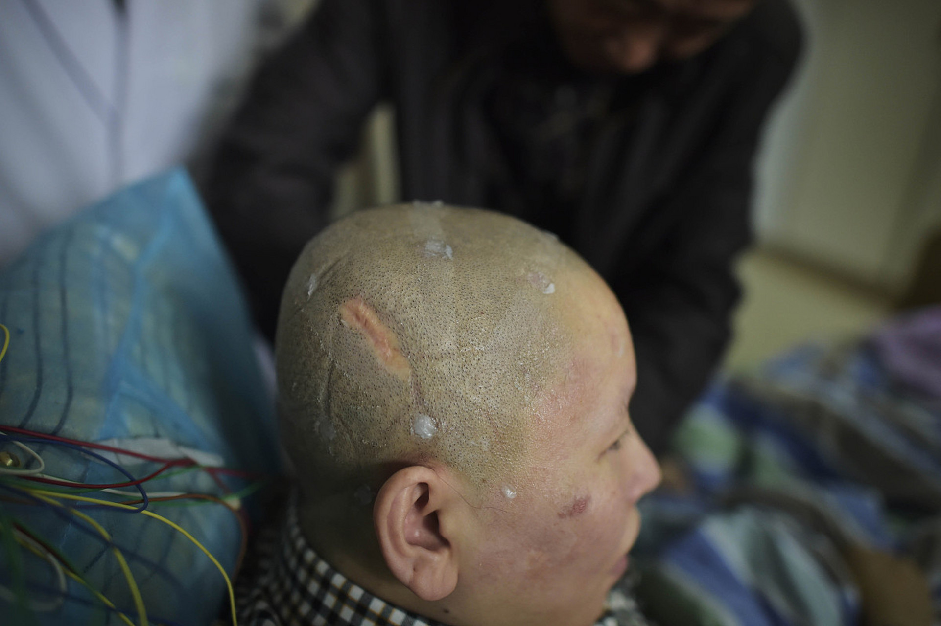 脑外伤后发生癫痫的概率有多高?