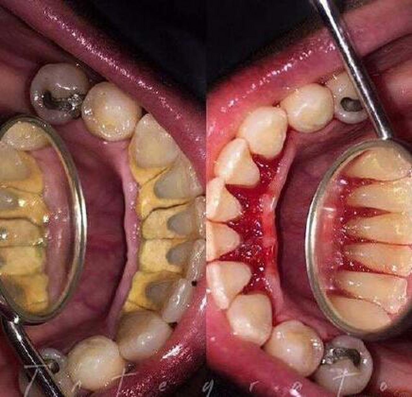 牙龈下的结石"你看不见牙龈的杀手 长期不清理牙结石,会损伤牙龈黏