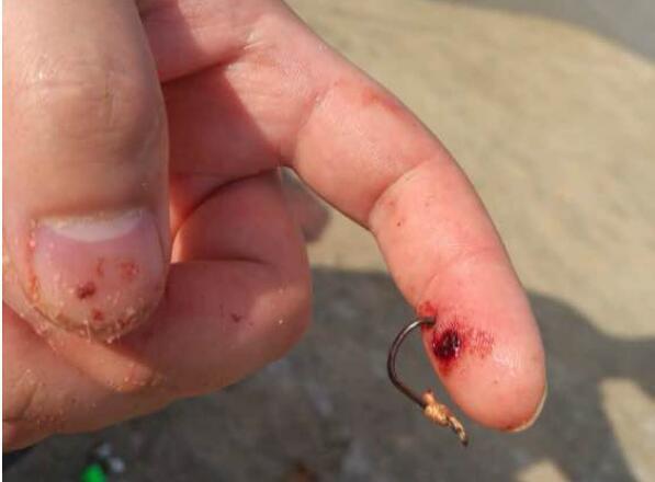 鱼钩勾到手,自行解决的办法