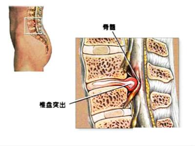 腰间盘突出只用这一招就够了