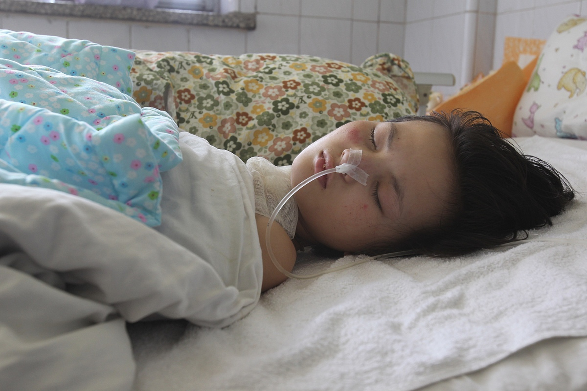 父母抹酒精退烧致4岁女儿住进icu#:酒精渗入皮肤引发急性酒精中毒