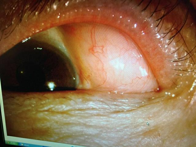 左眼球上长开心果大小软肉哈尔滨57岁男子患上眼眶脂肪瘤