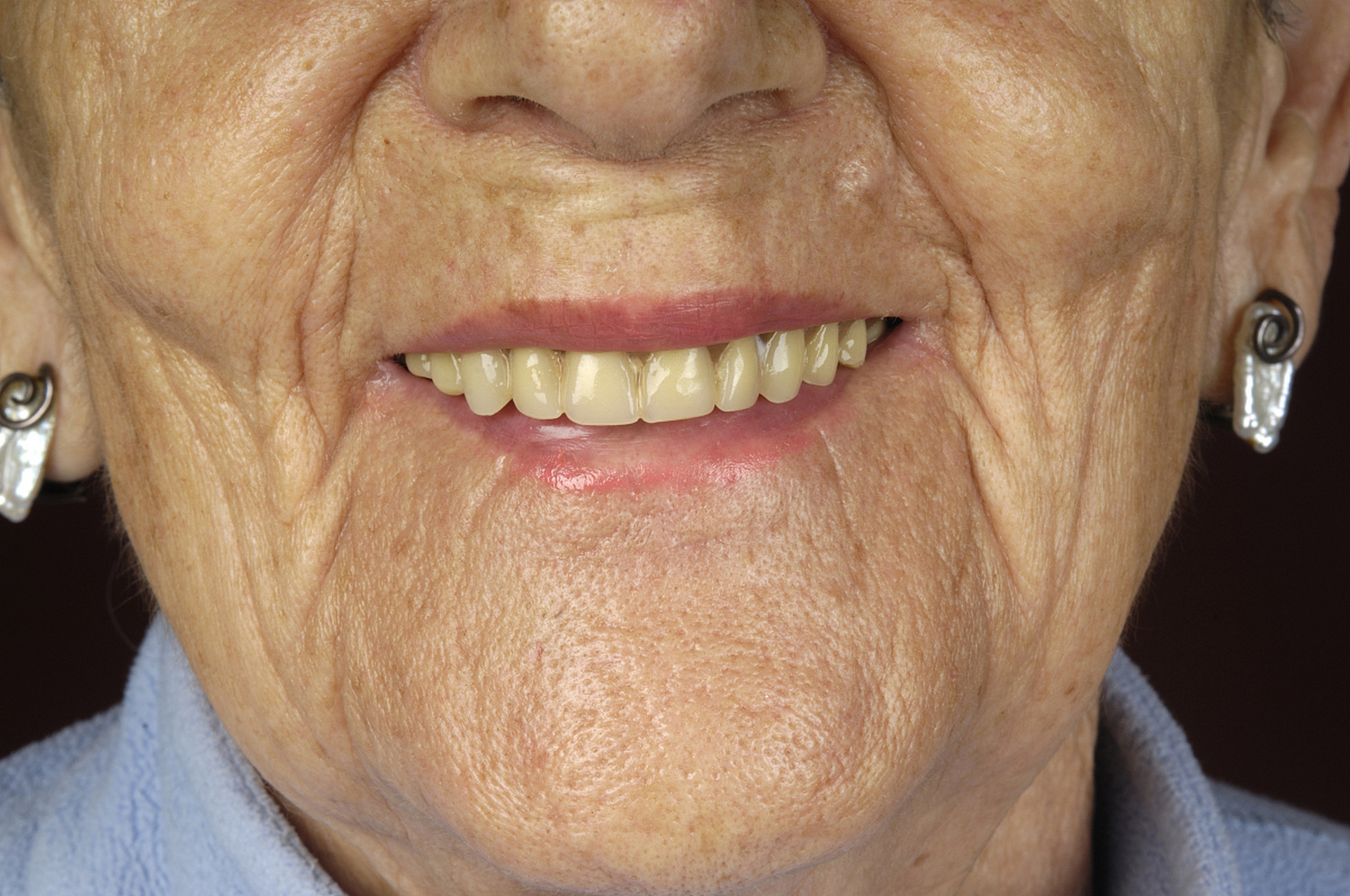 口周衰老嘴唇变薄怎么解决?