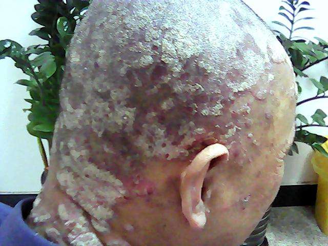 老年银屑病治愈率