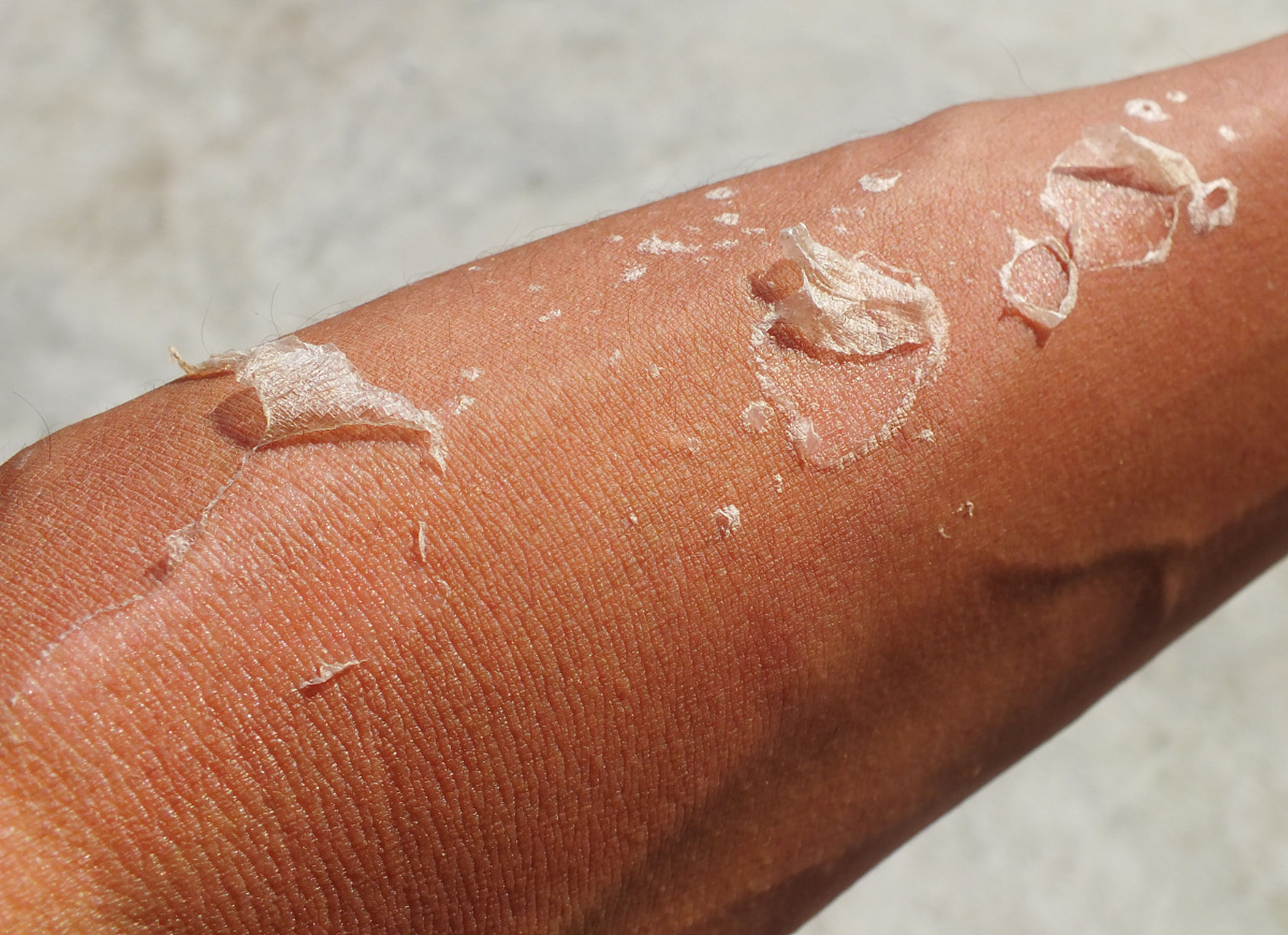 补水:晒伤后皮肤会失去大量水分,因此补充水分对于修复非常重要.