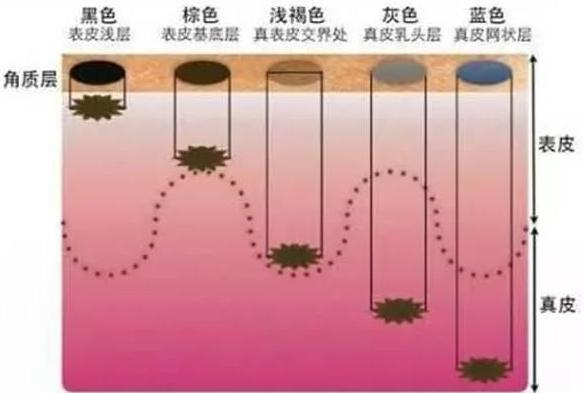 新生儿为什么会有这些青斑?真是蒙古王子转世?这才是真正原因