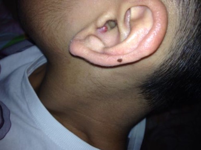 耳朵长痘痘是什么原因引起的?