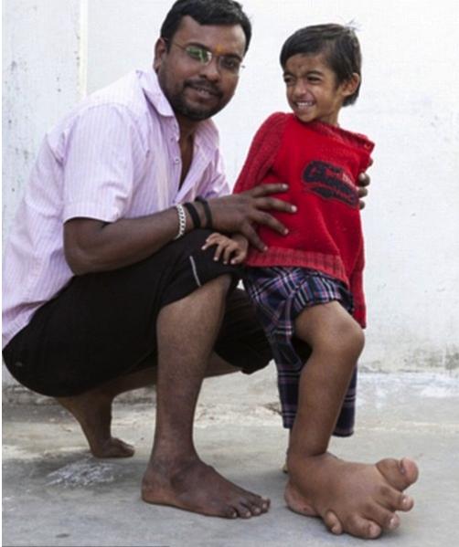 天下奇闻,印度4岁男孩右脚重达11斤,医学无法解释!