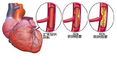 心脏搭桥手术流程图解图片