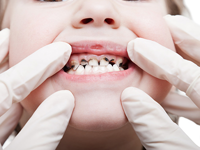 儿童避免龋齿的发生从小做起