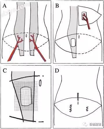 自体深部下腹部穿支(diep)皮瓣修复术后腹腔镜手术失败的气腹