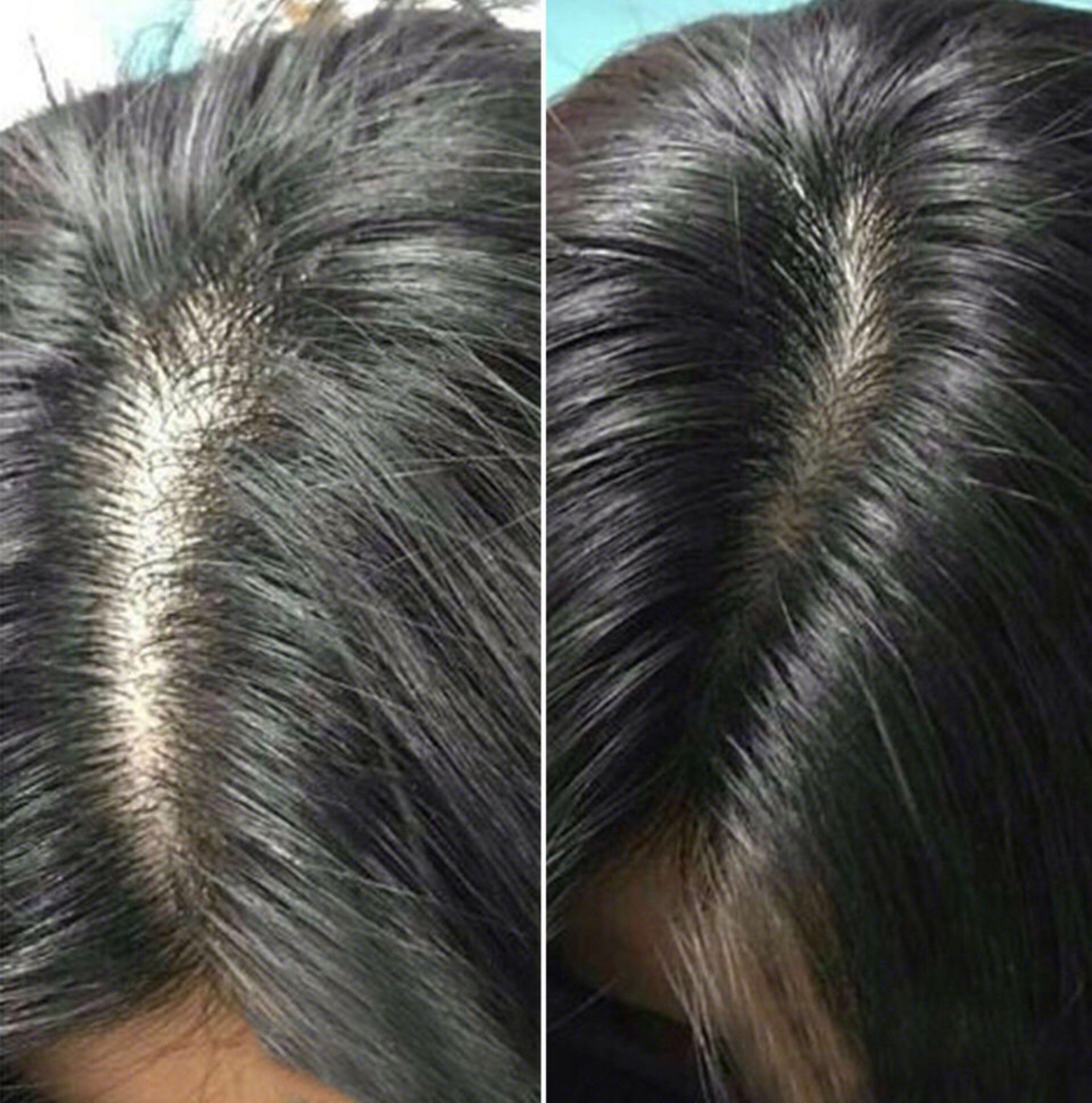 女生脱发,发际线后移严重,大多因为犯了这5个错误,你中了吗?