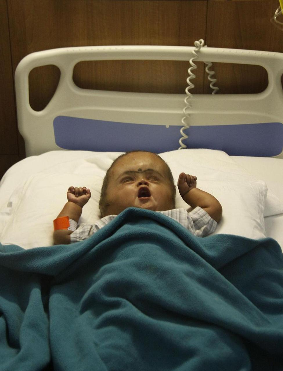 脑积水在中医属于解颅,囟填,大头儿等范畴,认为多发于小儿,为先天