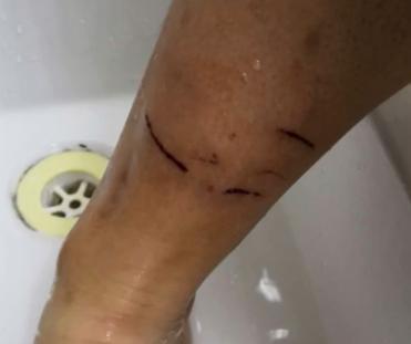恶犬发疯撕咬两名儿童 孩子颈部被咬鲜血直流!受伤严重!