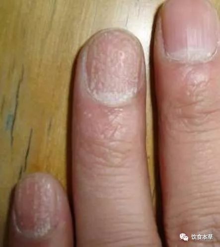 指甲上面的健康密码:学会了,很多病自己就有谱了