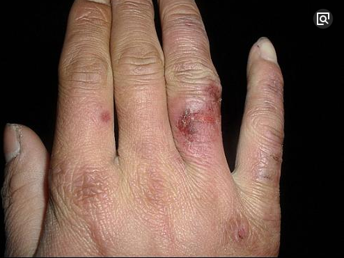 坐办公室冻的手脚长冻疮,药店阿姨教我用这个水,竟然只要1块钱