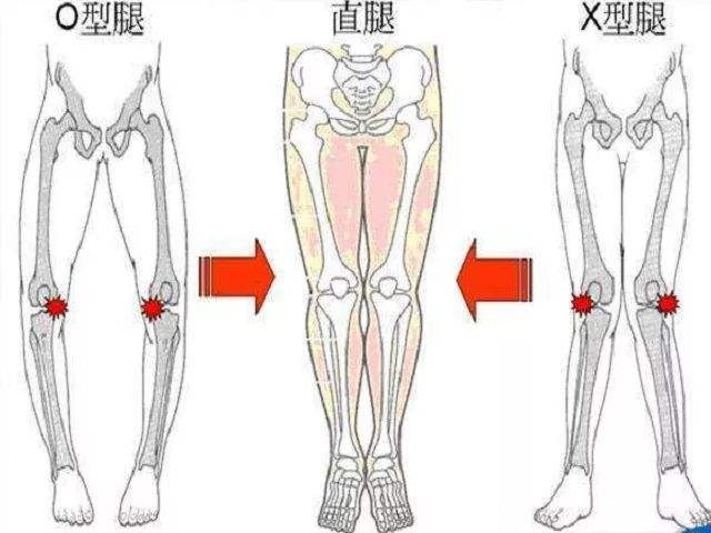 孩子走路罗圈腿,正常吗?