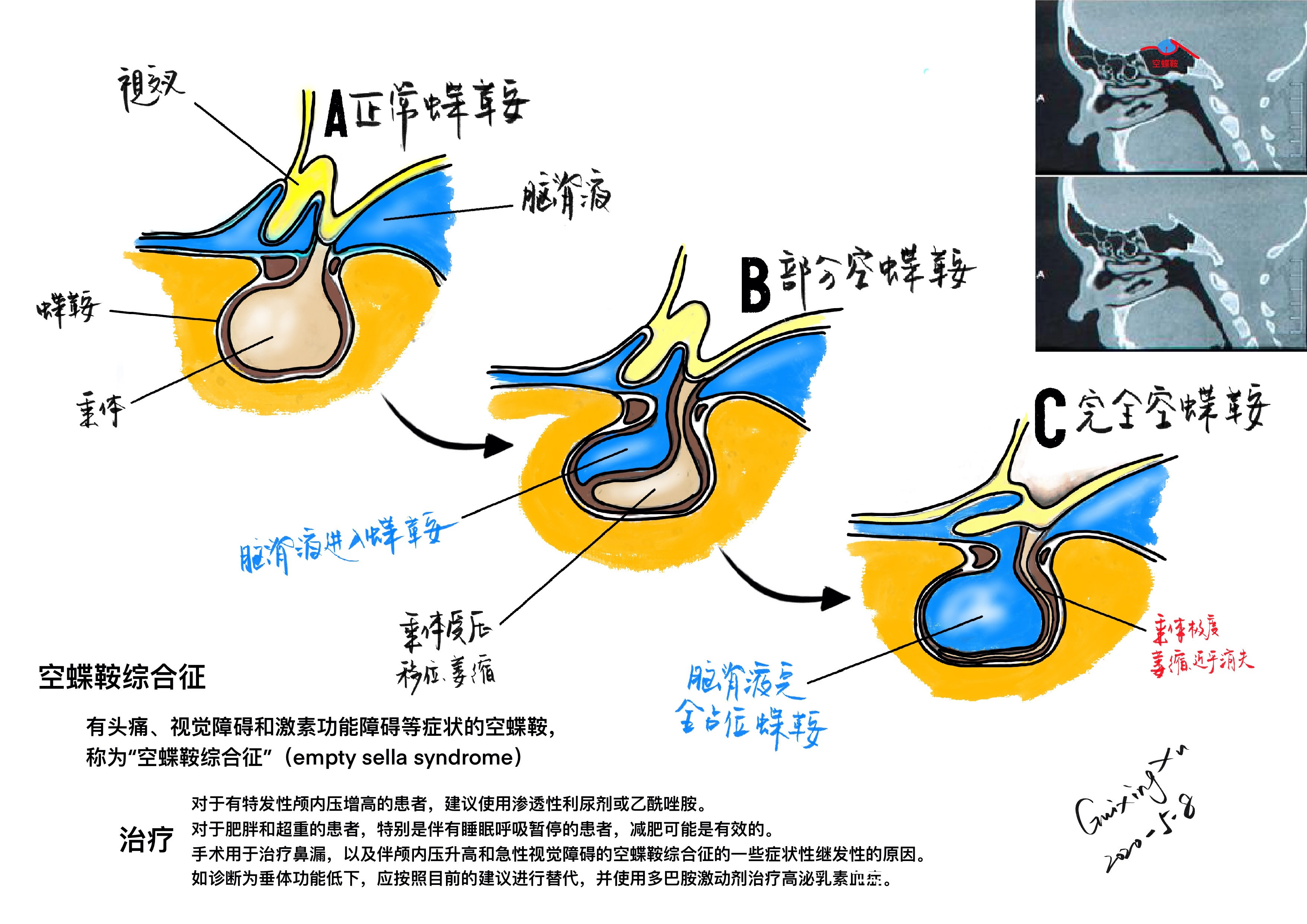 空蝶鞍综合征(手绘展示)