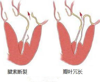 心脏二尖瓣脱垂,很严重吗?还能不能运动?