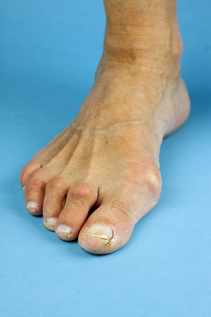 脚底痛风的症状及治疗方法?