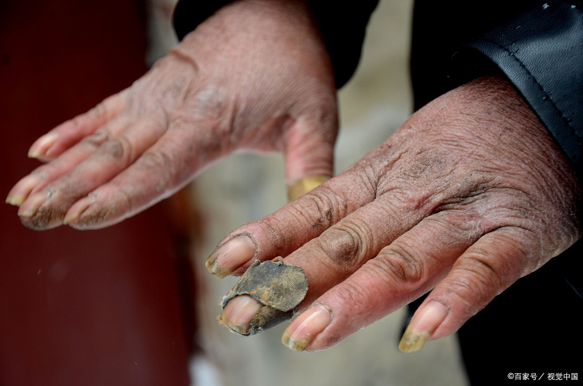 每到冬天,不少朋友的手都会被冻伤,真是让人苦恼