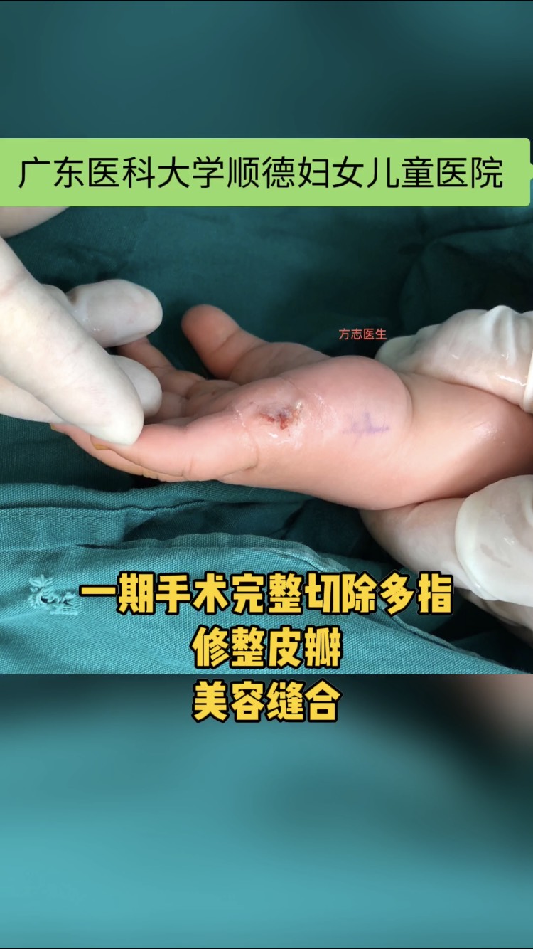 肉赘型多指的正确治疗方式