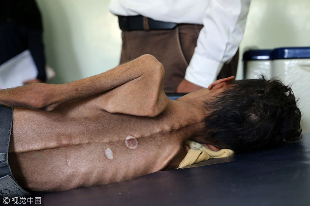 也门战争中儿童瘦成皮包骨令人心碎