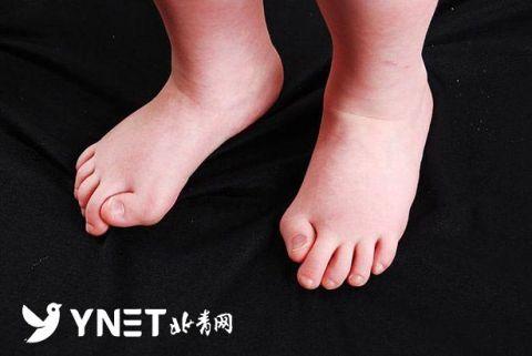 俄罗斯2岁宝宝患罕见"石人综合征" 逐渐僵化成活雕塑