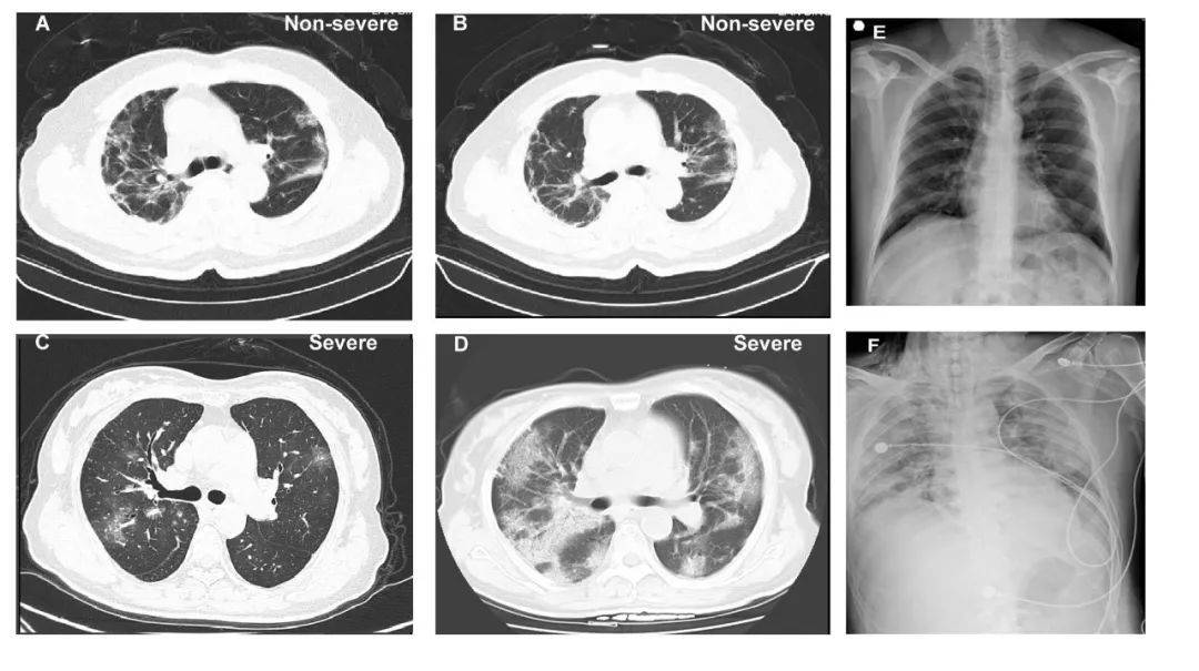 钟南山领衔发布近1100例新冠肺炎患者临床数据!