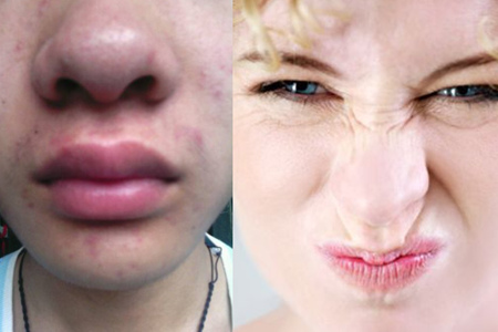 草莓鼻和酒糟鼻差别如此之大 这些方法可以助你摆脱鼻子的烦恼