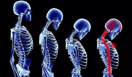 颈椎生理曲度变直有没有可能恢复?