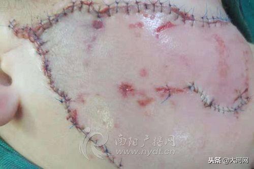 心疼!南阳3岁半男童被狗咬烂半张脸 缝了近百针