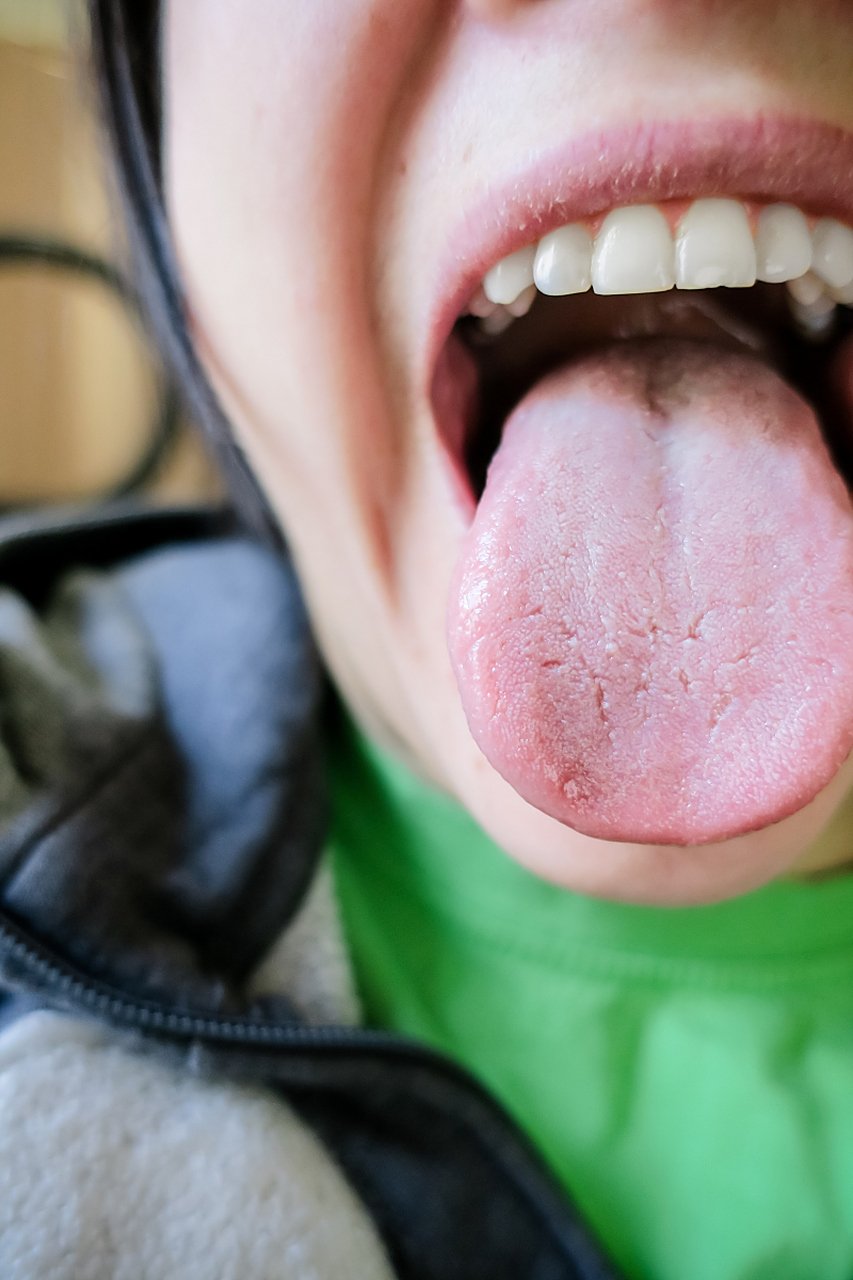 看看自己的舌头,是不是以下几种体质  每天早晨醒来,对着镜子观察一下