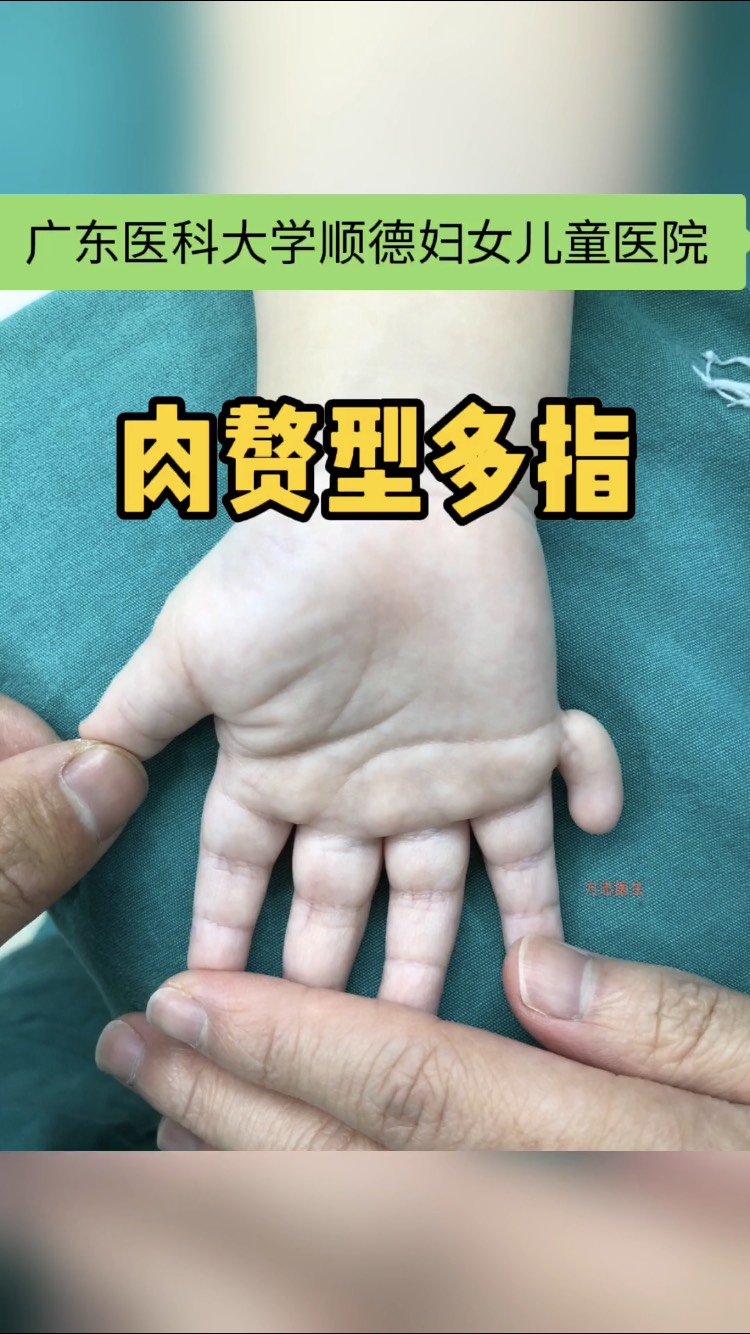 肉赘型多指的正确治疗方式