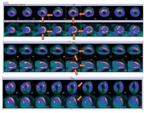 揭开「现代医学高科技之冠」PET/CT 的神秘面纱