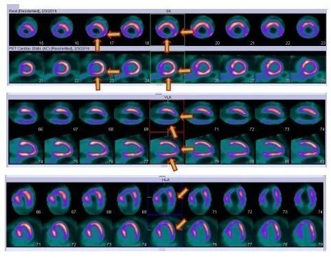 揭开「现代医学高科技之冠」PET/CT 的神秘面纱