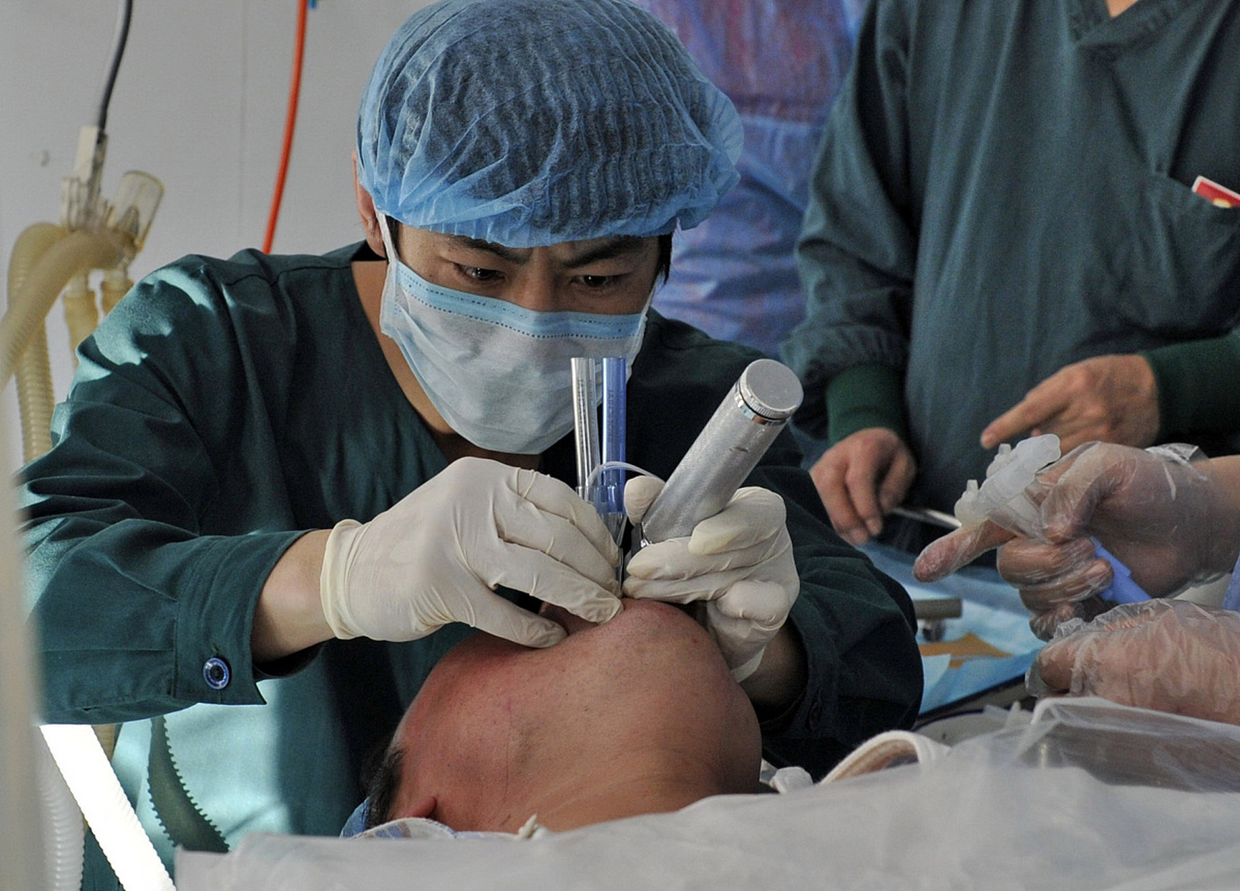 前段时间做了台"洗肺"手术,患者是一名50岁的女性,确诊了肺泡蛋白沉积