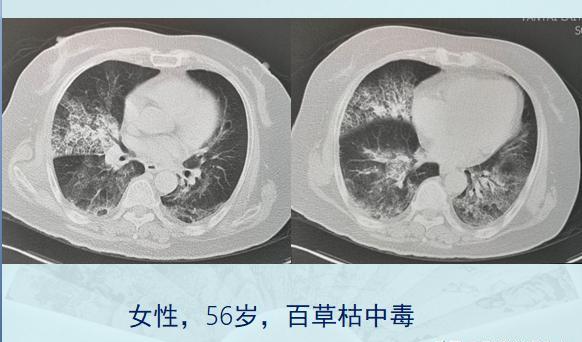 百草枯中毒肺部图片图片