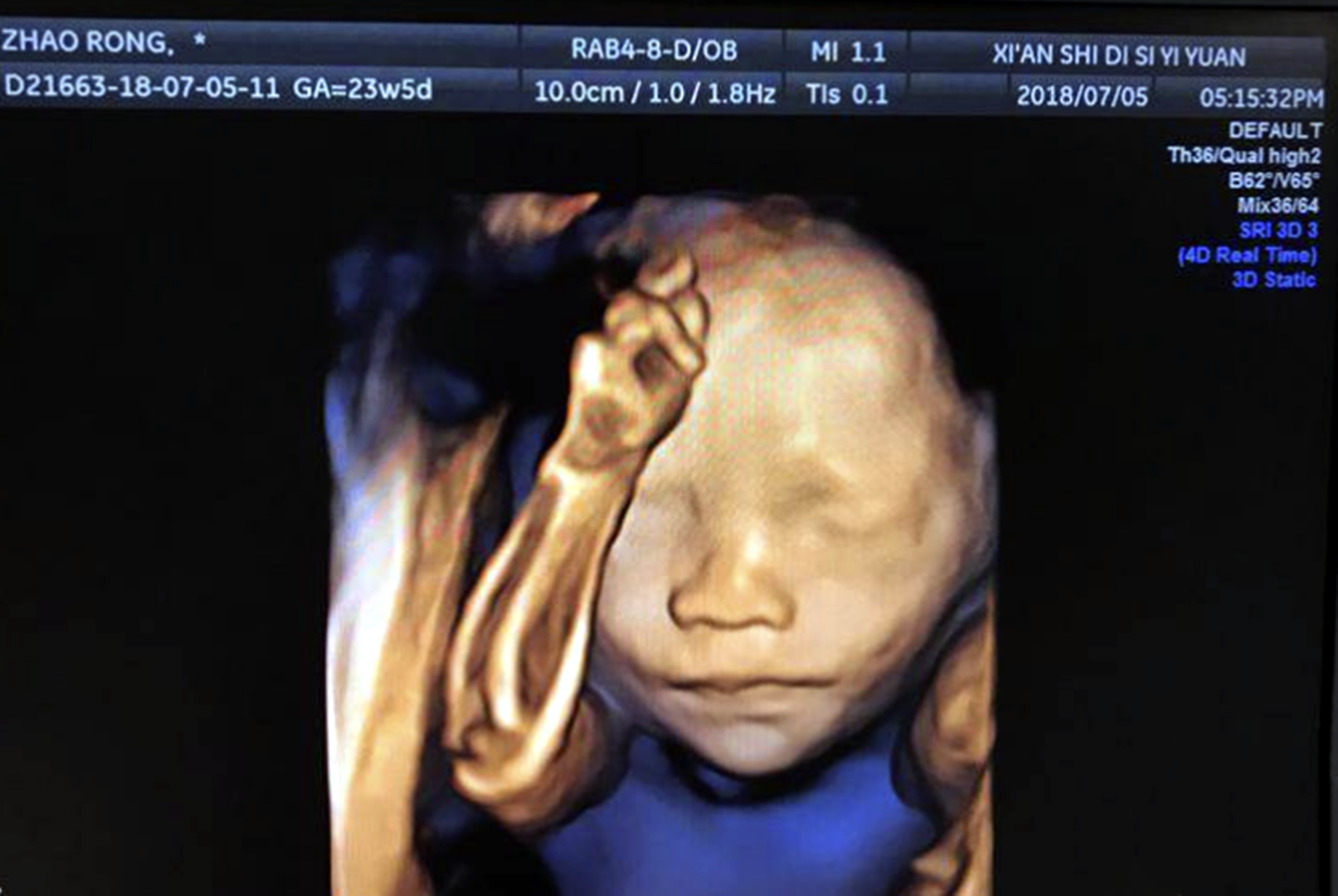 胎儿四维照鼻梁塌陷,宝爸质疑妈妈基因伪劣,出生后却很惊喜