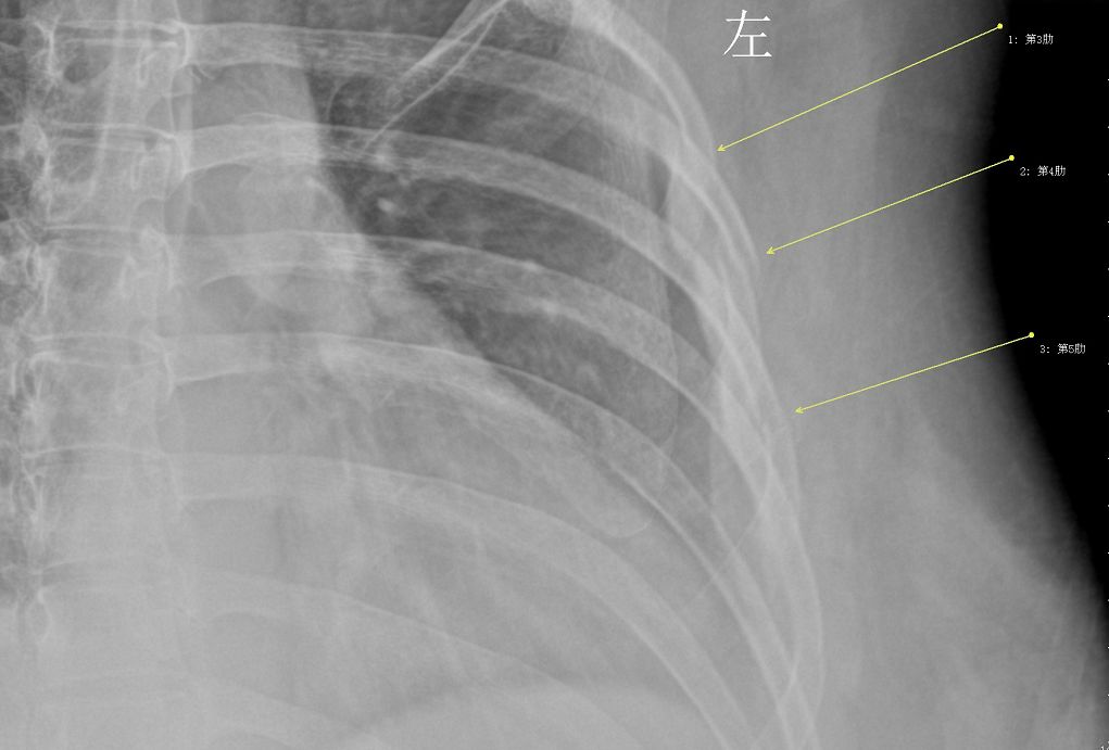 女子咳嗽幾聲,結果3根肋骨斷了!一天能喝10杯咖啡,醫生說