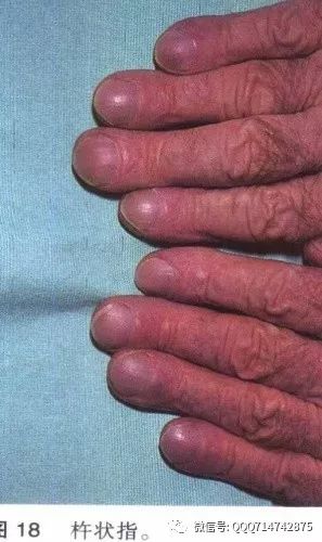 肺癌手指的变化图片图片